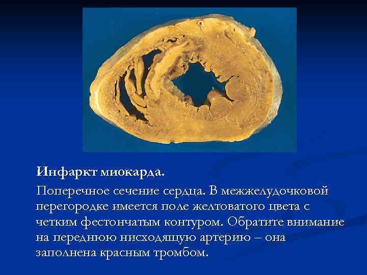 Инфаркт миокарда. Поперечное сечение сердца. В межжелудочковой перегородке имеется поле желтоватого цвета с четким