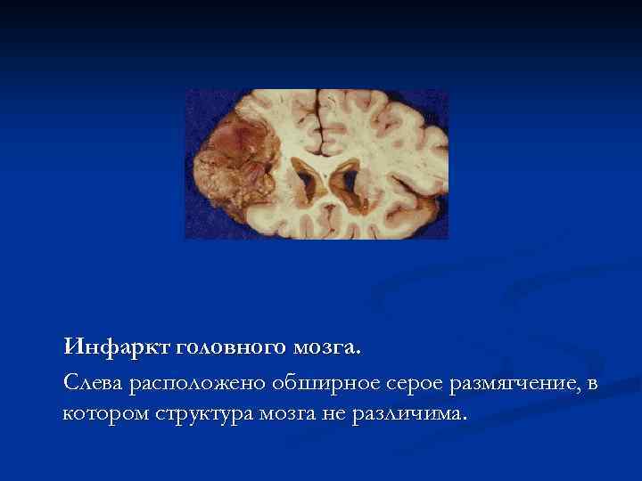 Инфаркт головного мозга. Слева расположено обширное серое размягчение, в котором структура мозга не различима.