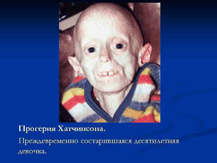 Прогерия Хатчинсона. Преждевременно состарившаяся десятилетняя девочка. 