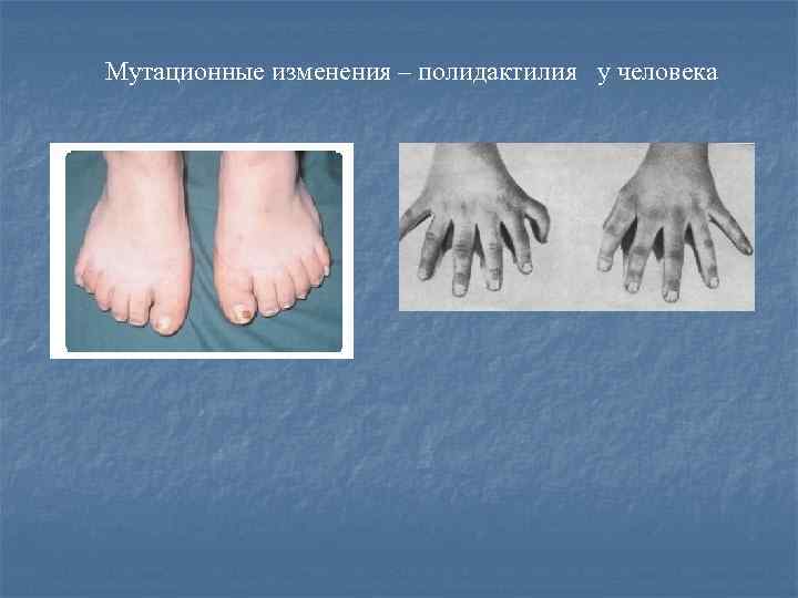 Мутационные изменения – полидактилия у человека 