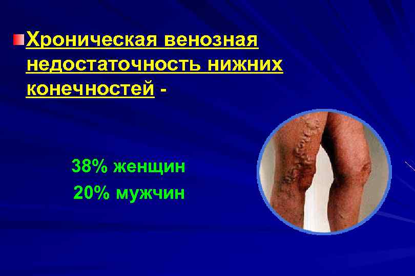 Хроническая венозная недостаточность нижних конечностей - 38% женщин 20% мужчин 
