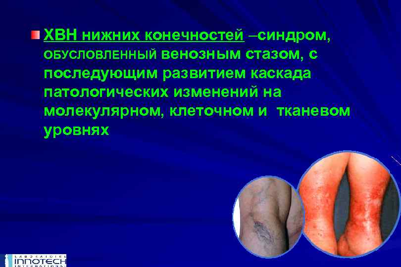 ХВН нижних конечностей –синдром, ОБУСЛОВЛЕННЫЙ венозным стазом, с последующим развитием каскада патологических изменений на