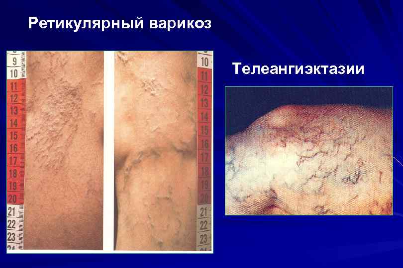 Ретикулярный варикоз Телеангиэктазии 