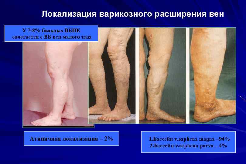 Локализация варикозного расширения вен У 7 -8% больных ВБНК сочетается с ВБ вен малого