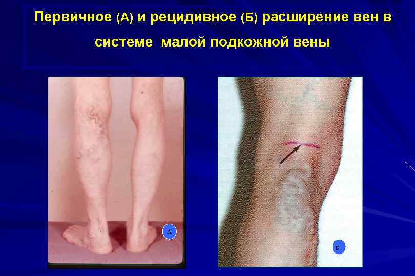 Первичное (А) и рецидивное (Б) расширение вен в системе малой подкожной вены А Б