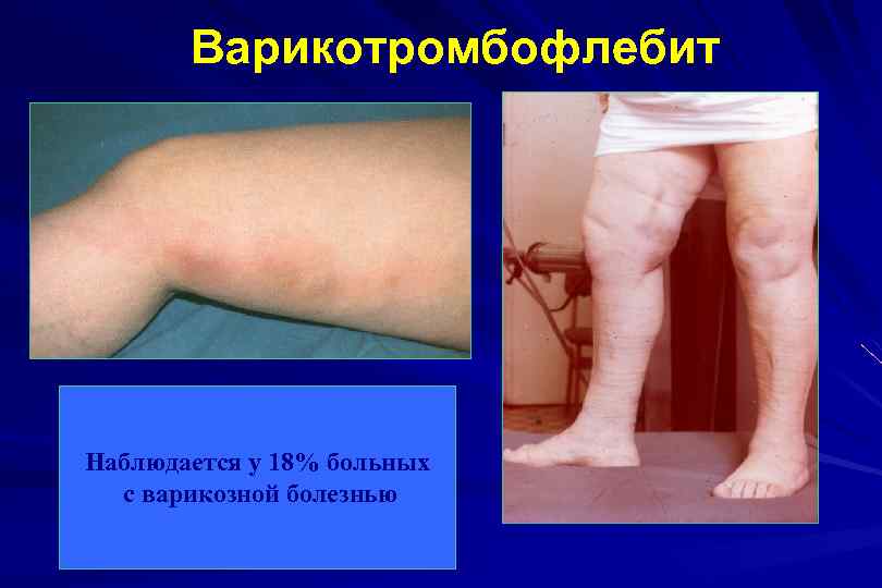 Варикотромбофлебит Наблюдается у 18% больных с варикозной болезнью 