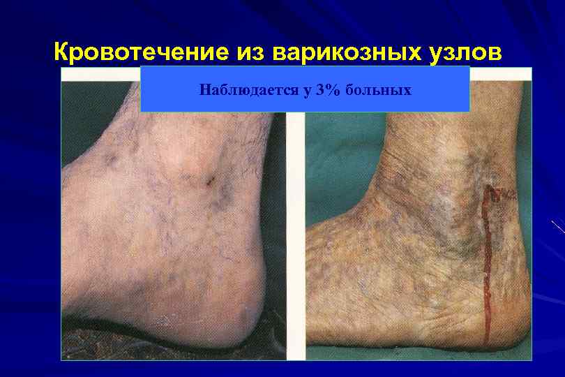 Кровотечение из варикозных узлов Наблюдается у 3% больных 