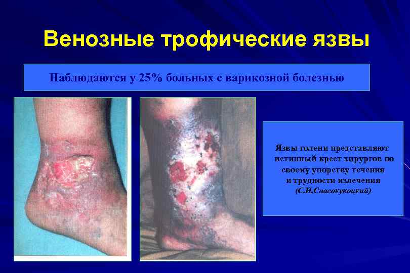 Венозные трофические язвы Наблюдаются у 25% больных с варикозной болезнью Язвы голени представляют истинный