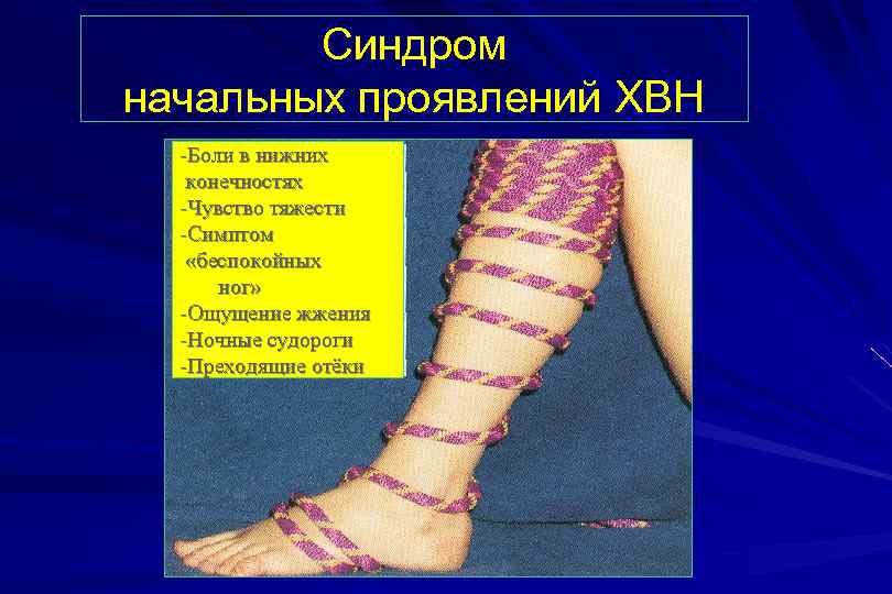 Синдром начальных проявлений ХВН -Боли в нижних конечностях -Чувство тяжести -Симптом «беспокойных ног» -Ощущение