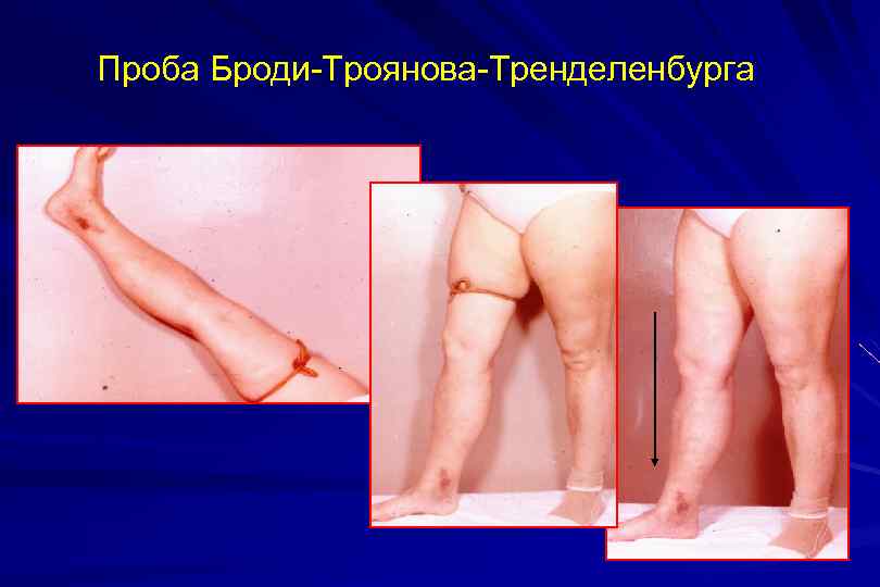 Проба Броди-Троянова-Тренделенбурга 