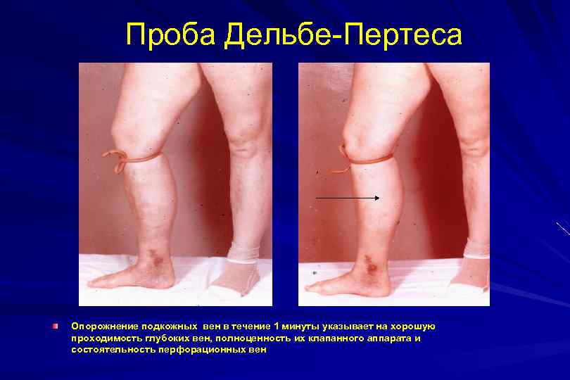 Проба Дельбе-Пертеса Опорожнение подкожных вен в течение 1 минуты указывает на хорошую проходимость глубоких