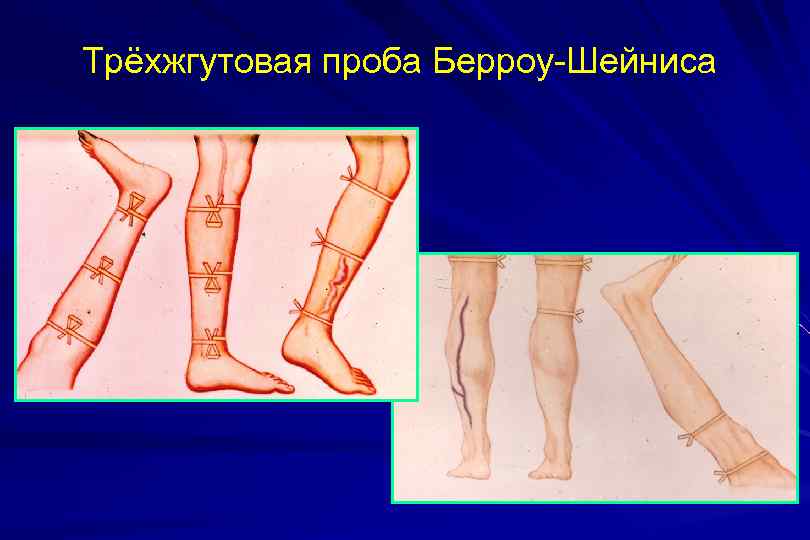 Трёхжгутовая проба Берроу-Шейниса 