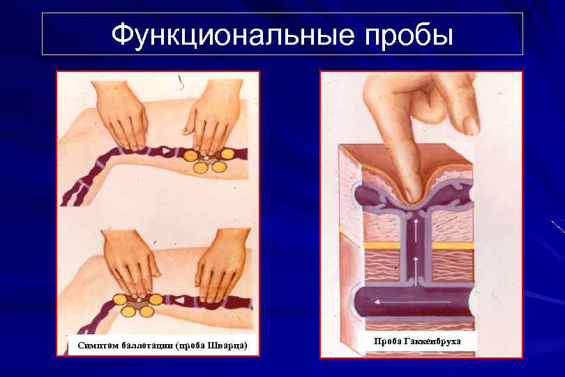 Функциональные пробы Симптом баллотации (проба Шварца) Проба Гаккенбруха 