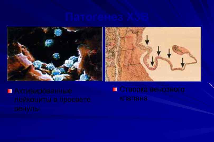 Патогенез Х 3 В Активированные лейкоциты в просвете венулы Створка венозного клапана 