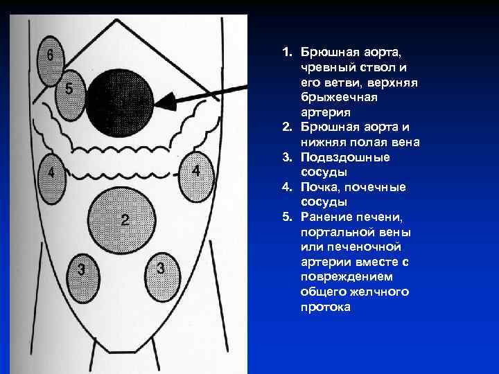 1. Брюшная аорта, чревный ствол и его ветви, верхняя брыжеечная артерия 2. Брюшная аорта