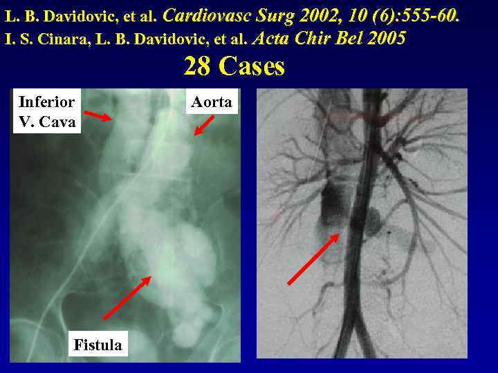 L. B. Davidovic, et al. Cardiovasc Surg 2002, 10 (6): 555 -60. I. S.