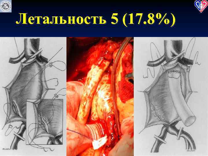 Летальность 5 (17. 8%) 