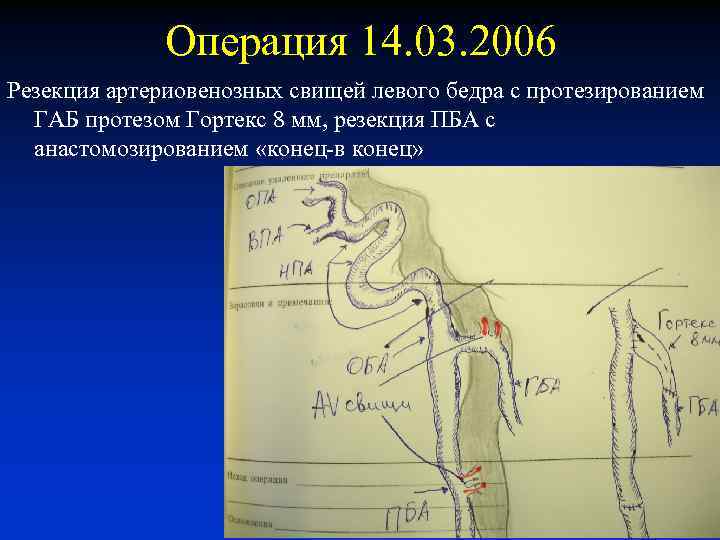 Операция 14. 03. 2006 Резекция артериовенозных свищей левого бедра с протезированием ГАБ протезом Гортекс