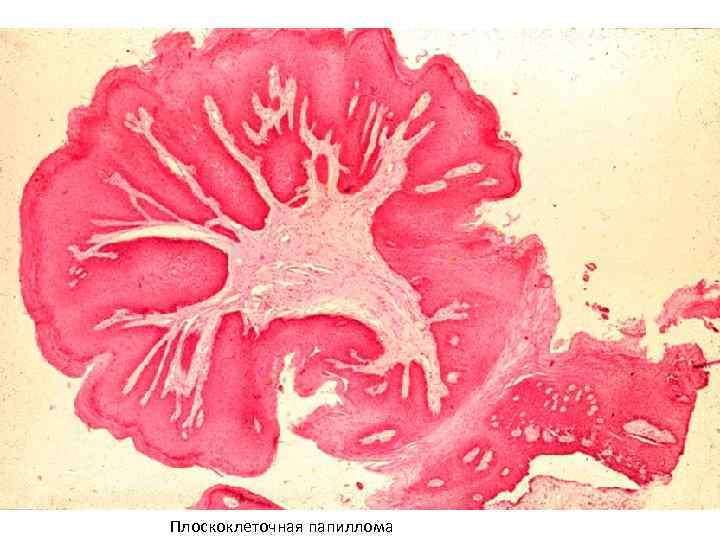 Плоскоклеточная папиллома 