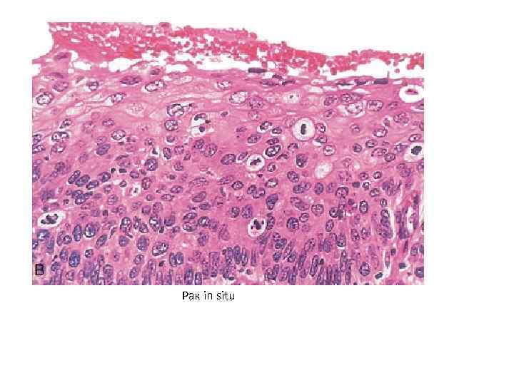 Рак in situ 