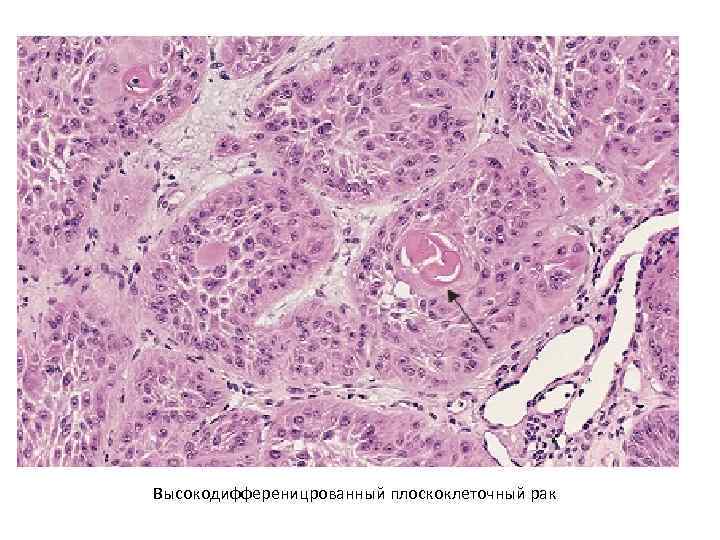 Высокодифференицрованный плоскоклеточный рак 