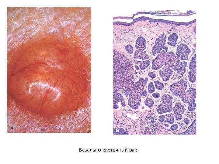 Базально-клеточный рак 