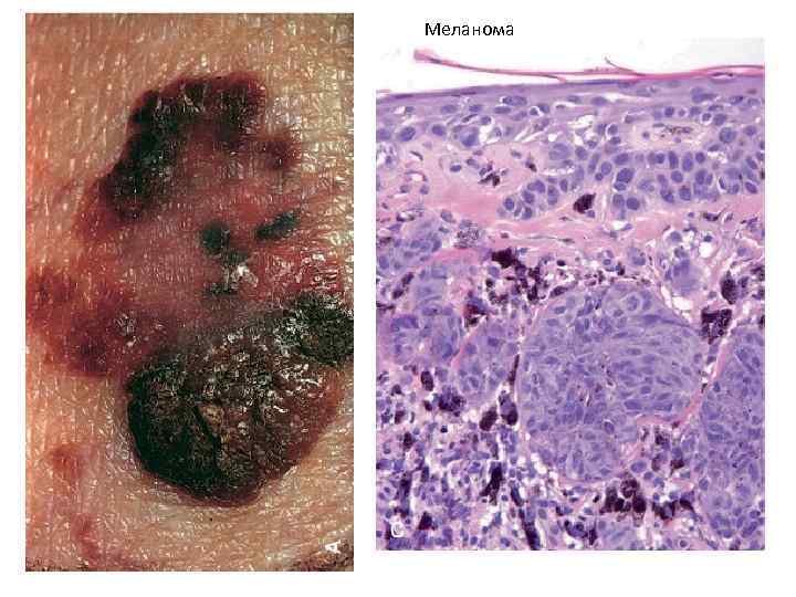 Меланома 