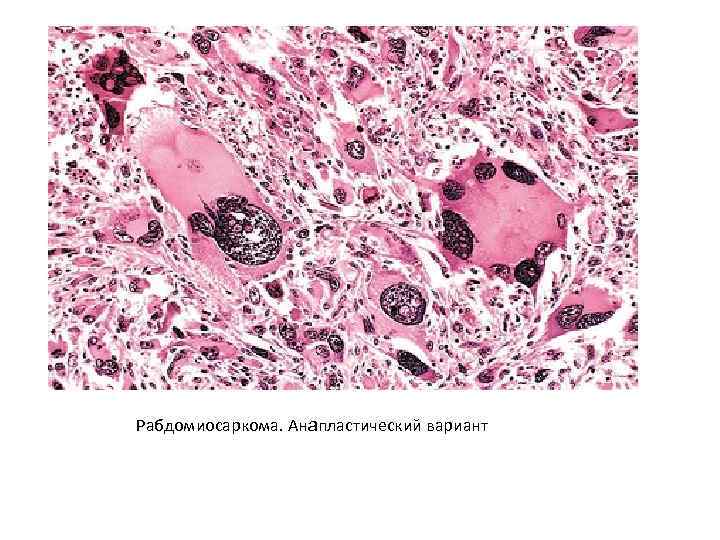 Рабдомиосаркома. Анапластический вариант 