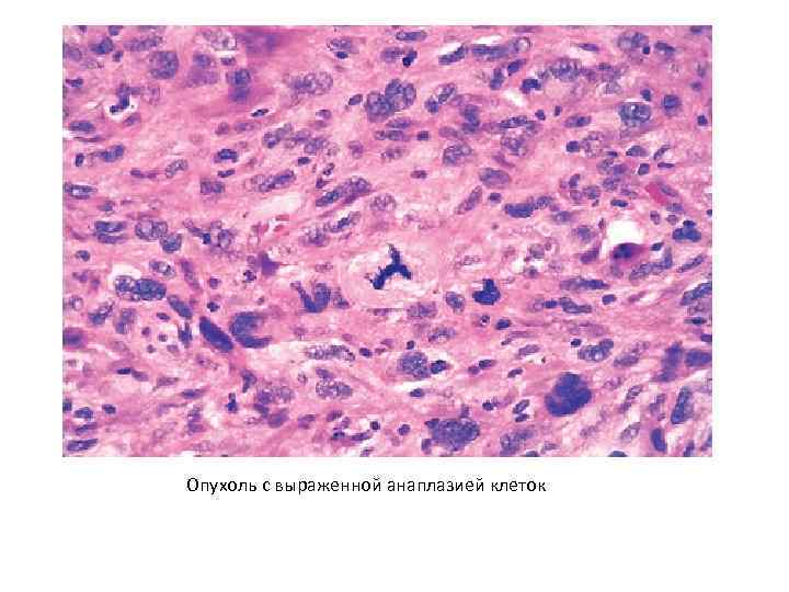 Опухоль с выраженной анаплазией клеток 