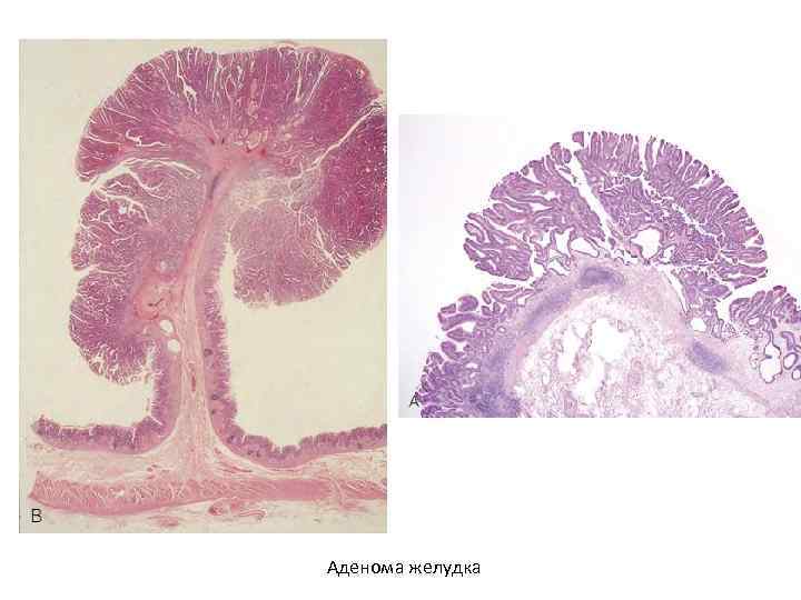 Эпителиальные опухоли патанатомия