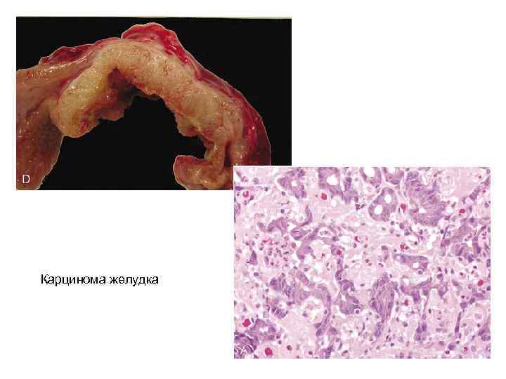 Карцинома желудка 