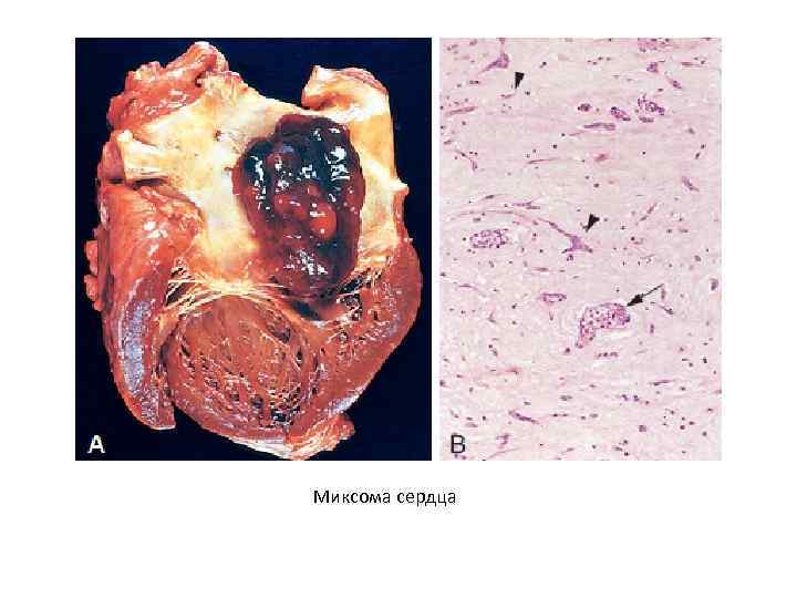 Миксома сердца 
