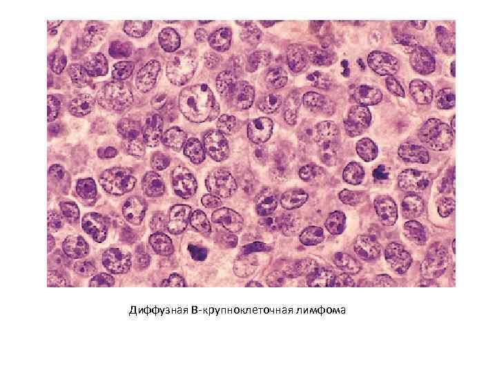 Диффузная B-крупноклеточная лимфома 