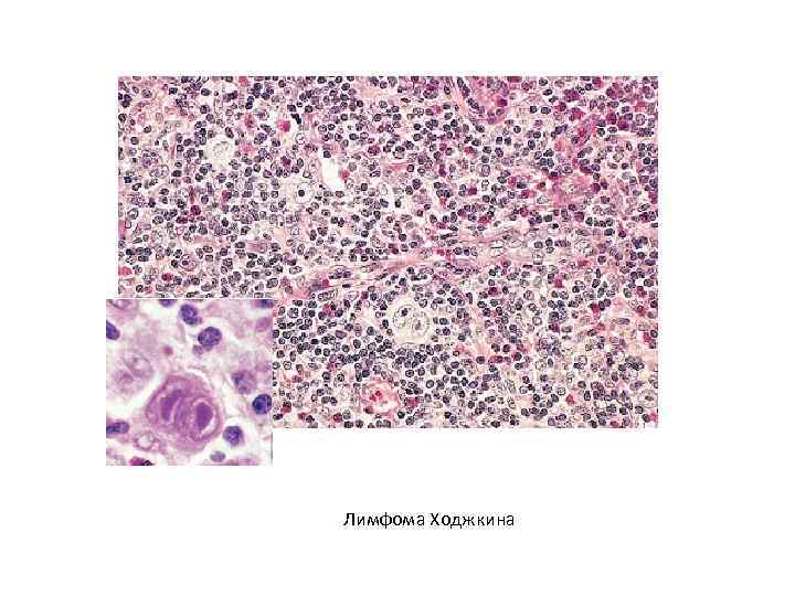 Лимфома Ходжкина 