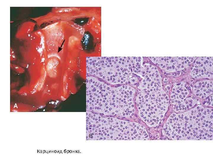 Карциноид бронха. 