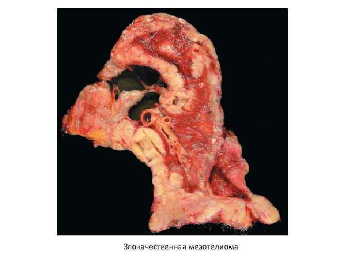 Злокачественная мезотелиома 