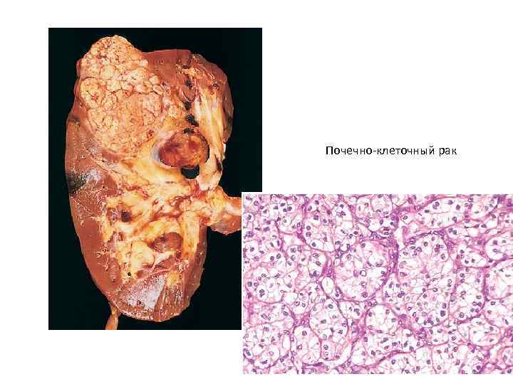 Почечно-клеточный рак 