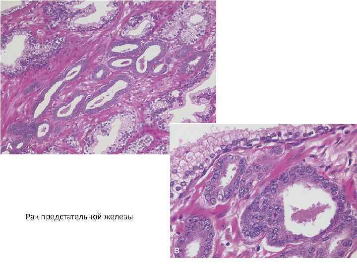 Рак предстательной железы 