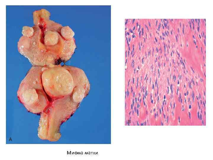 Миома матки 