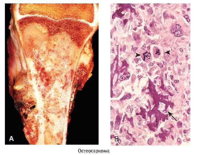 Остеосаркома 