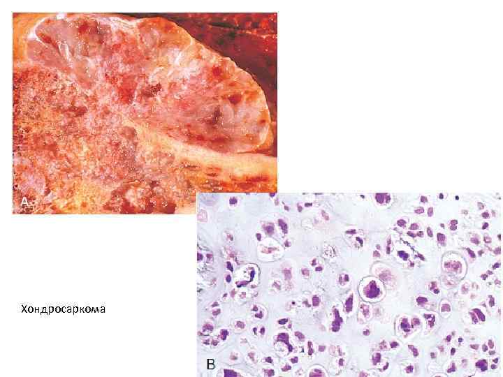 Хондросаркома 