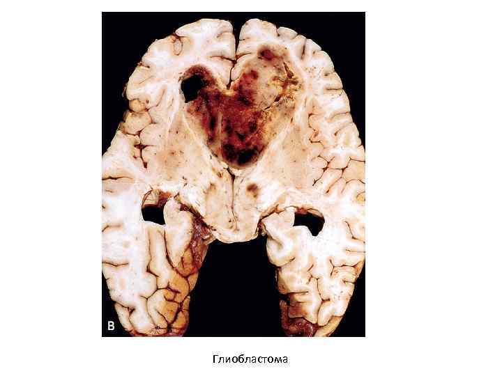 Глиобластома 