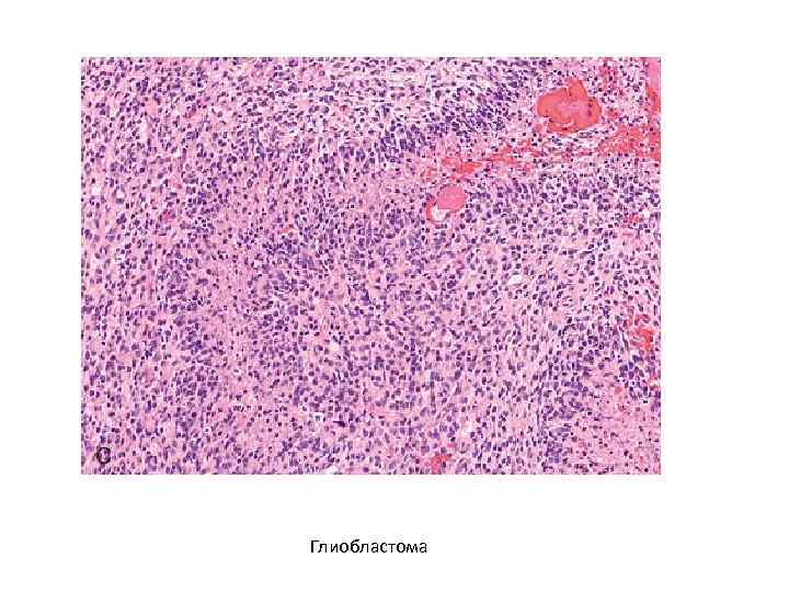 Глиобластома 
