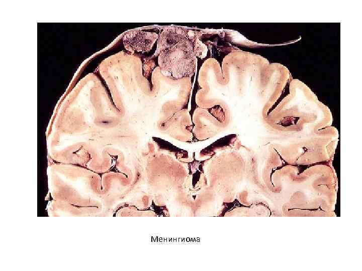 Менингиома 