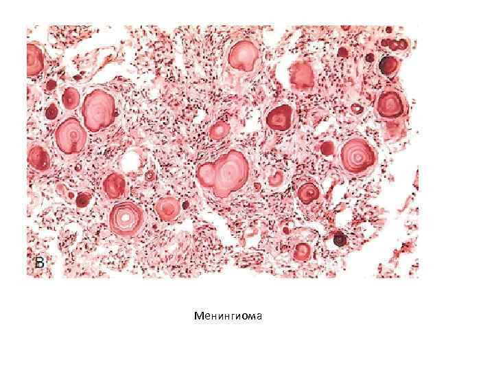 Менингиома 