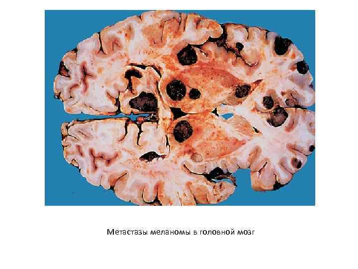 Метастазы меланомы в головной мозг 