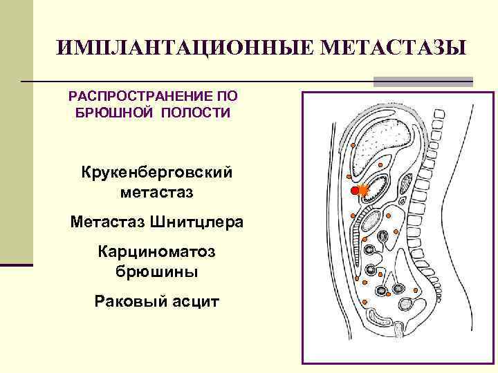 ИМПЛАНТАЦИОННЫЕ МЕТАСТАЗЫ РАСПРОСТРАНЕНИЕ ПО БРЮШНОЙ ПОЛОСТИ Крукенберговский метастаз Метастаз Шнитцлера Карциноматоз брюшины Раковый асцит