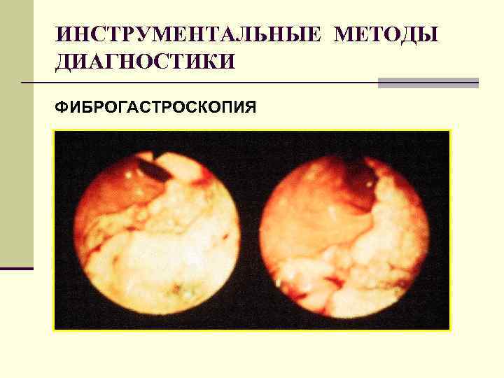 ИНСТРУМЕНТАЛЬНЫЕ МЕТОДЫ ДИАГНОСТИКИ ФИБРОГАСТРОСКОПИЯ 