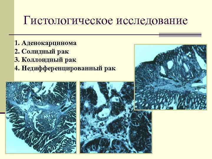 Гистологическое исследование 1. Аденокарцинома 2. Солидный рак 3. Коллоидный рак 4. Недифференцированный рак 