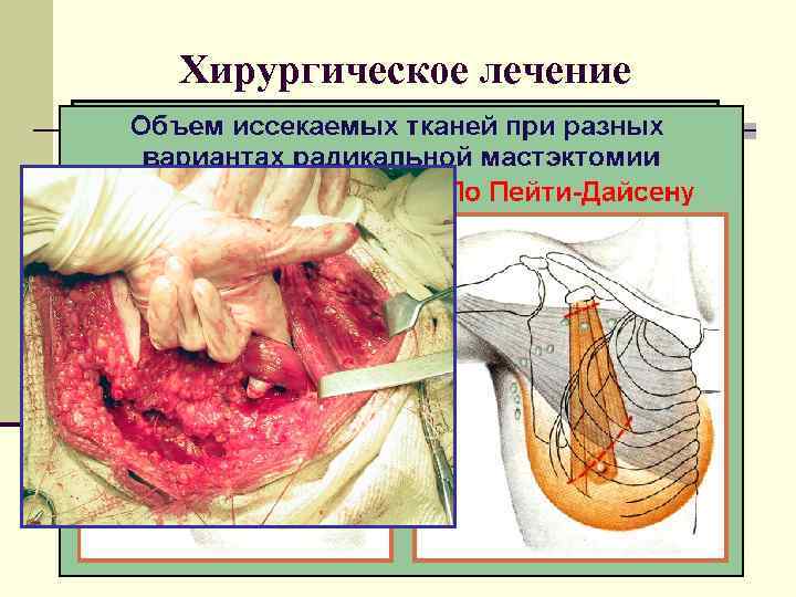 Хирургическое лечение 